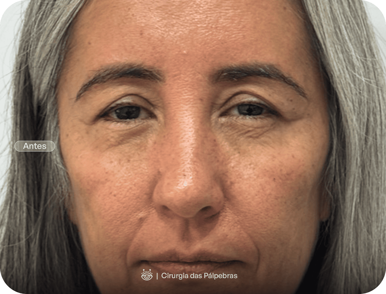 _ - Cirurgia-das-Pálpebras-copiar